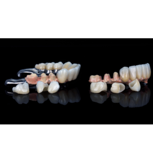 What is a Partial Dental Crown