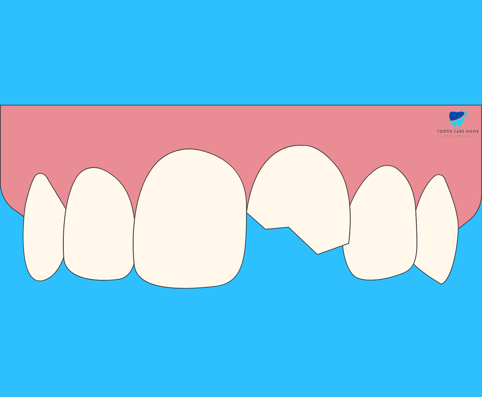 Fractured tooth