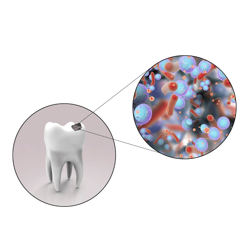 Cavity on a Filling