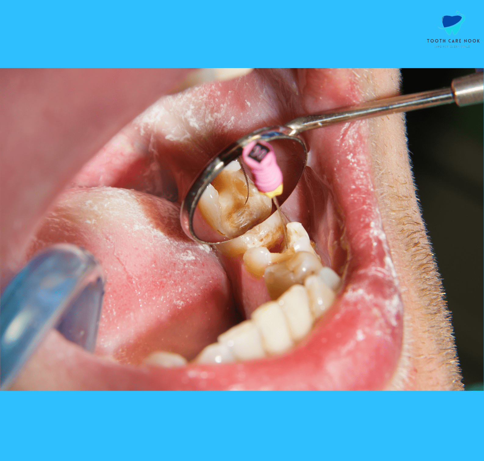 Root Fracture 