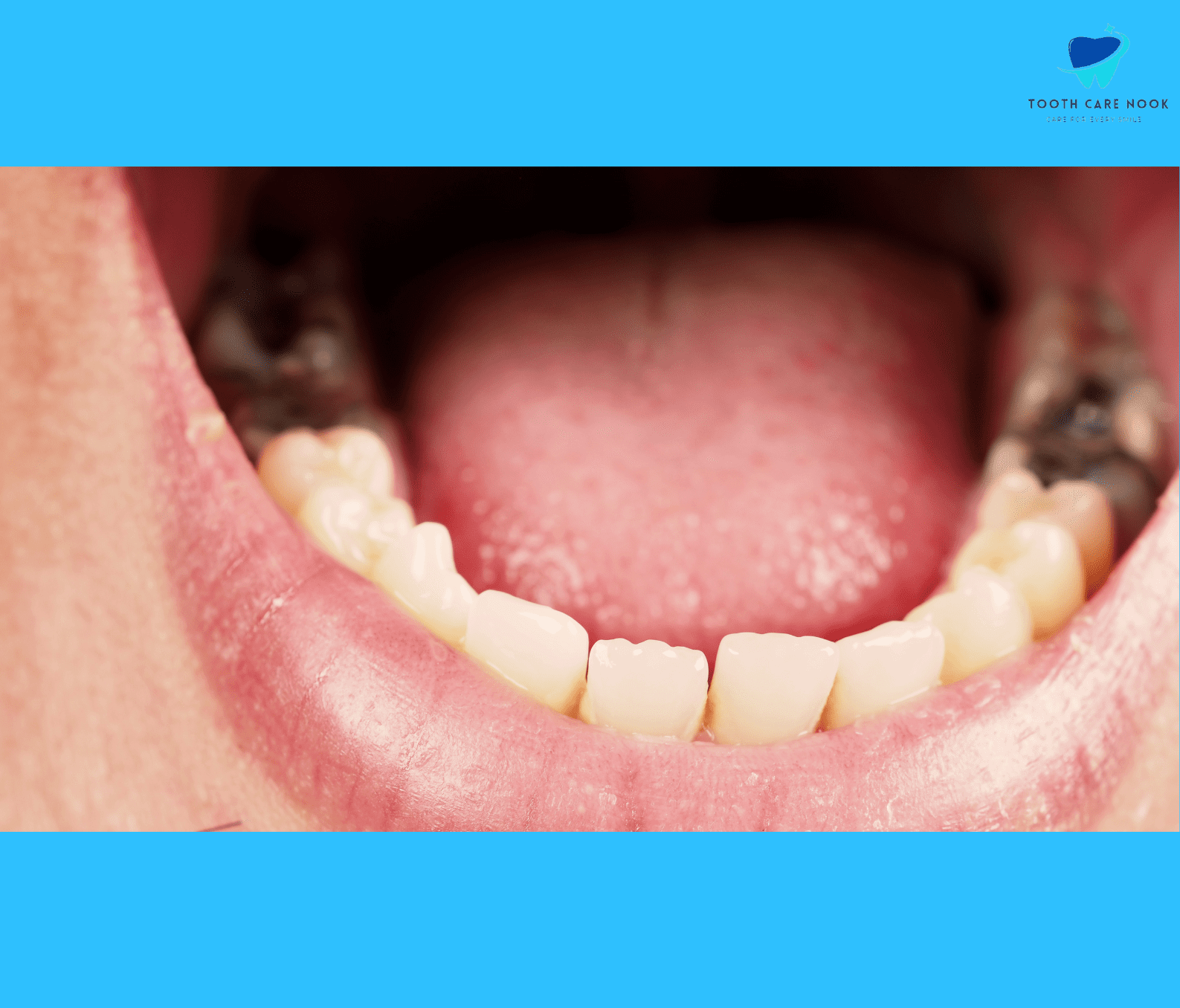 Signs of Tooth Attrition 