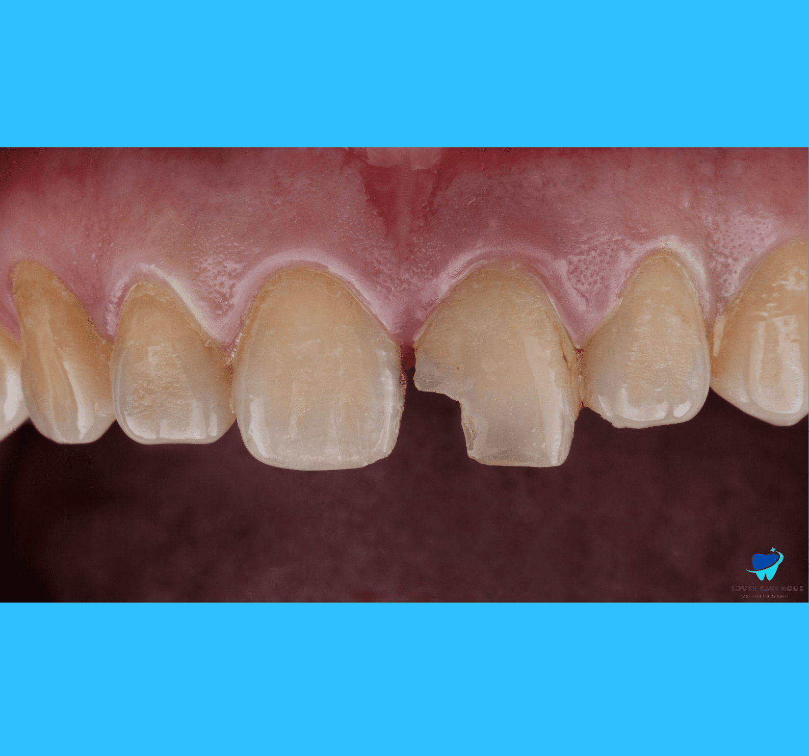 Tooth discoloration 