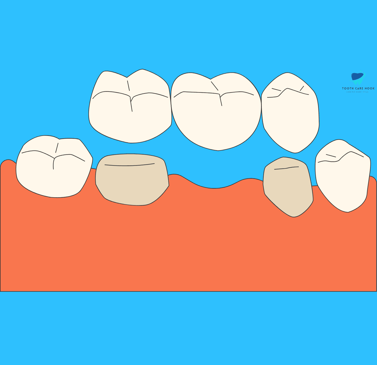 Dental Bridge