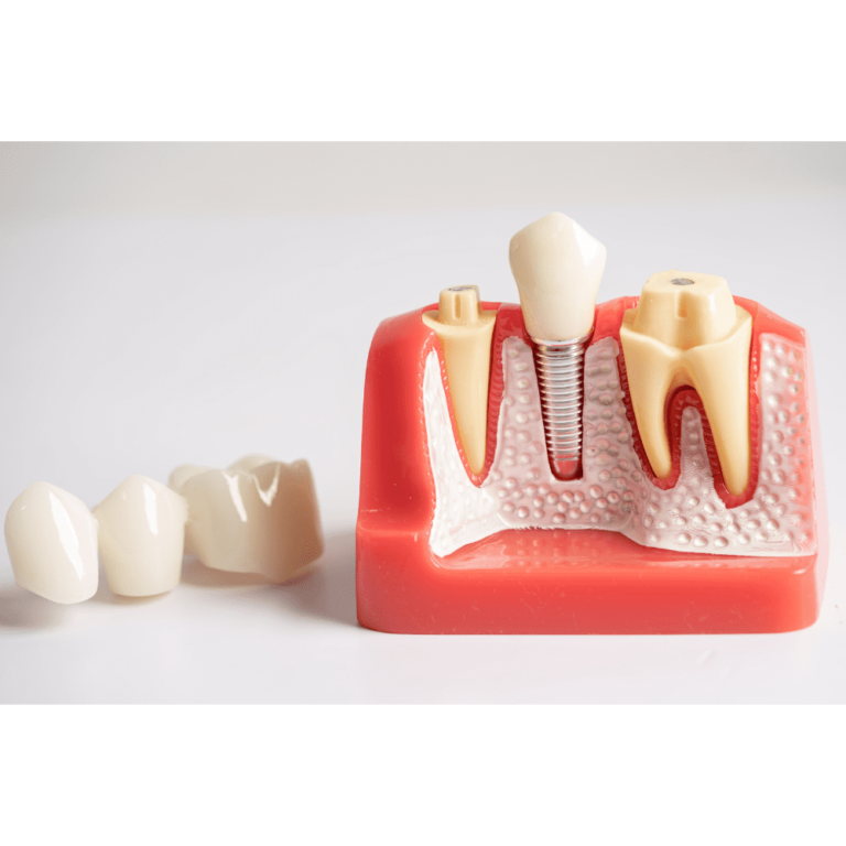 Can Cavity in Root Canal Tooth Develop