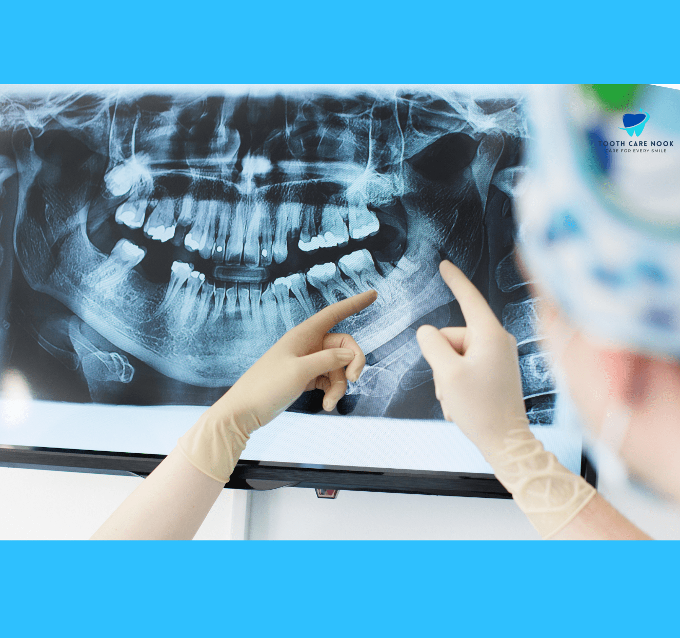 Hyperdontia X-ray 