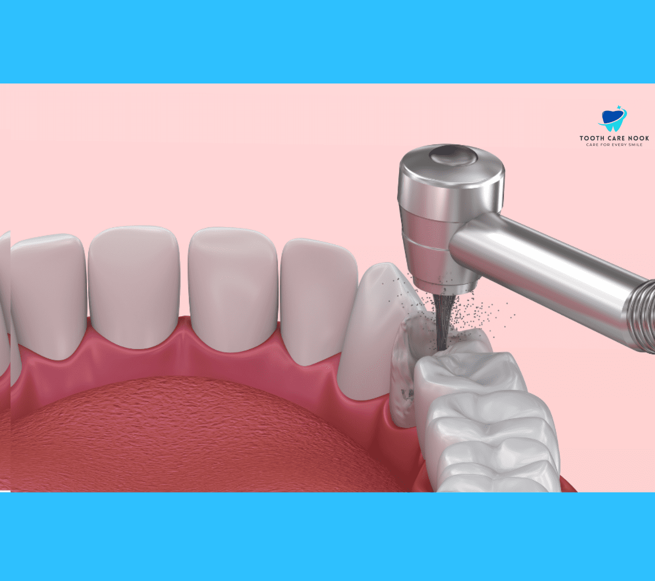 4 Root Canals in One Day 