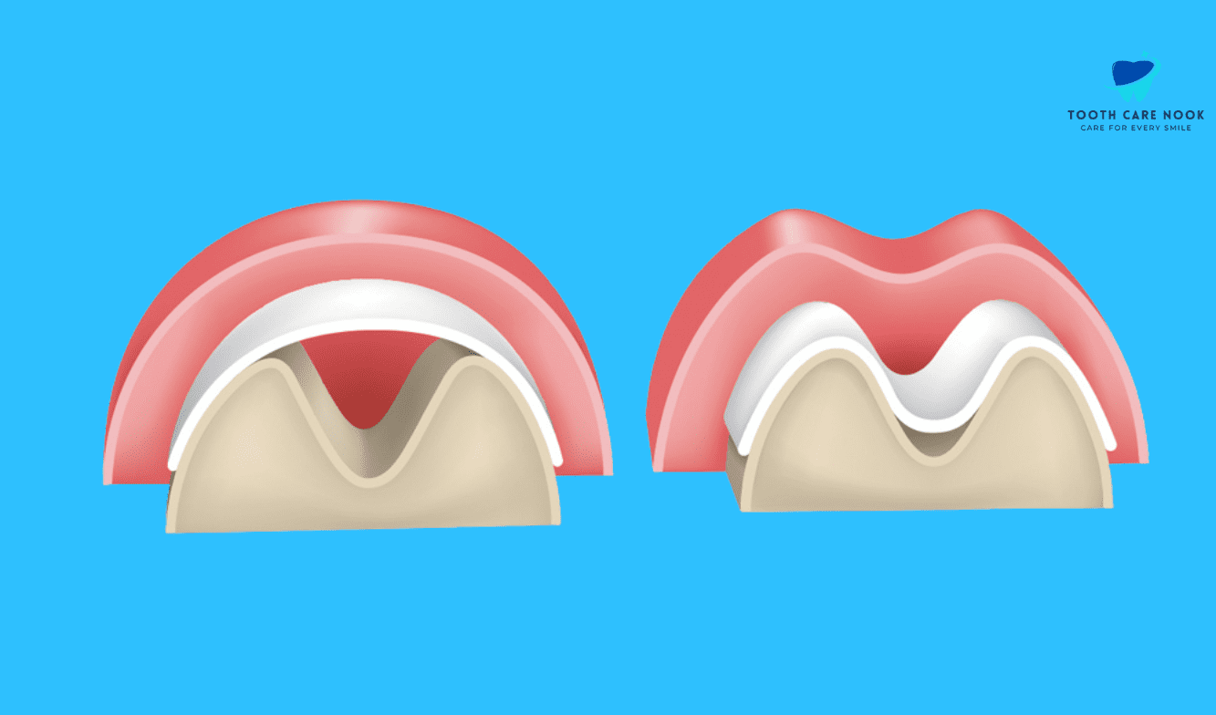 Barrier Membrane