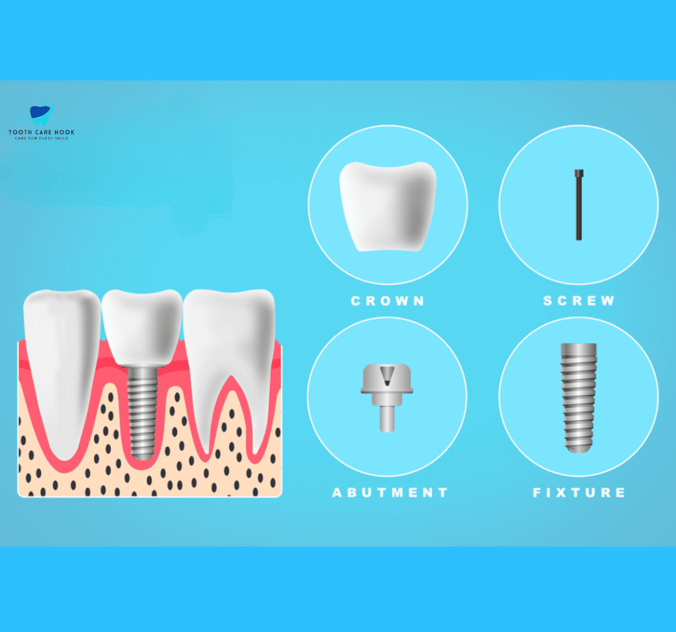 Dental Bridge Replacement Procedure 