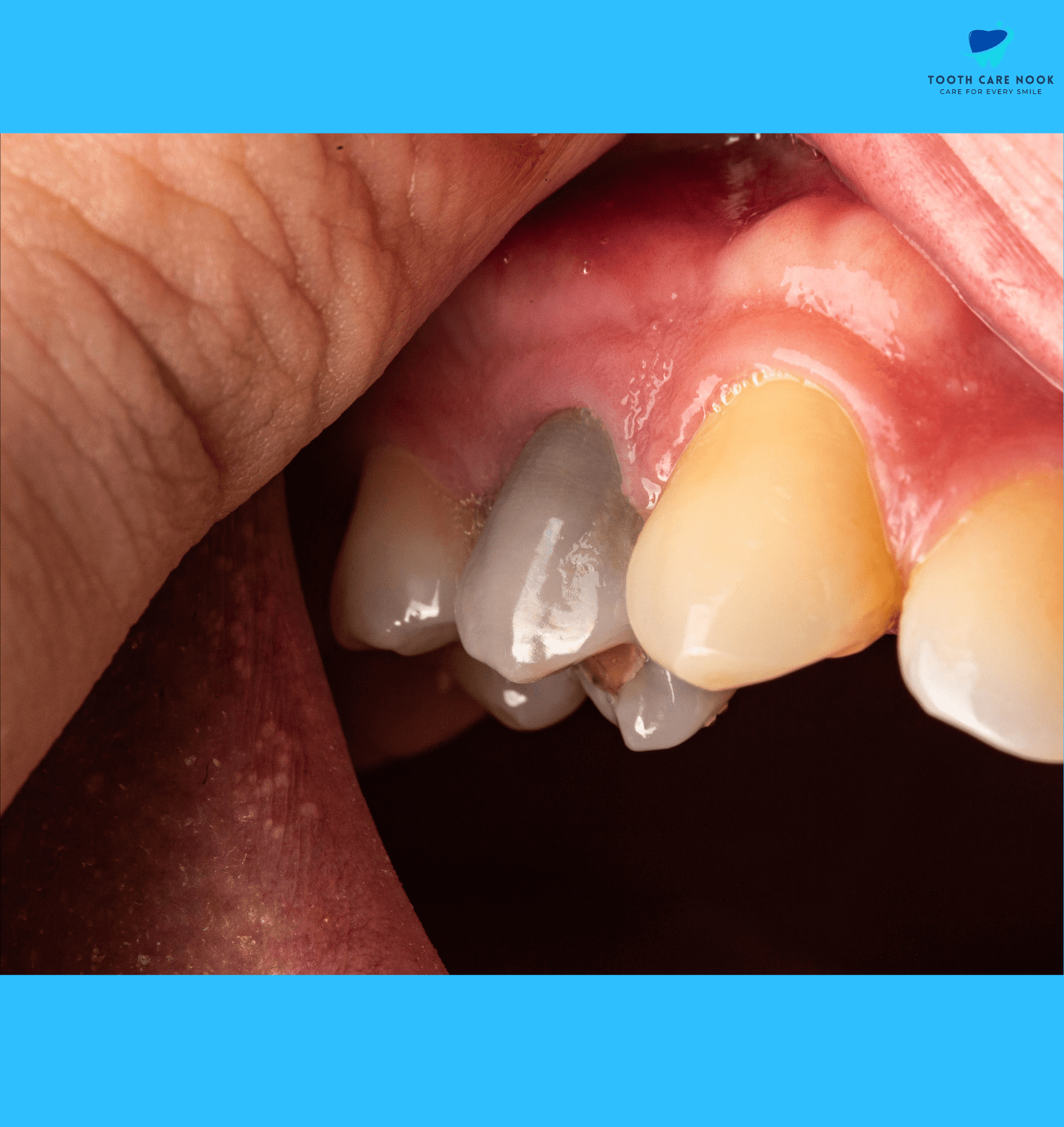 Dental Nerve Block