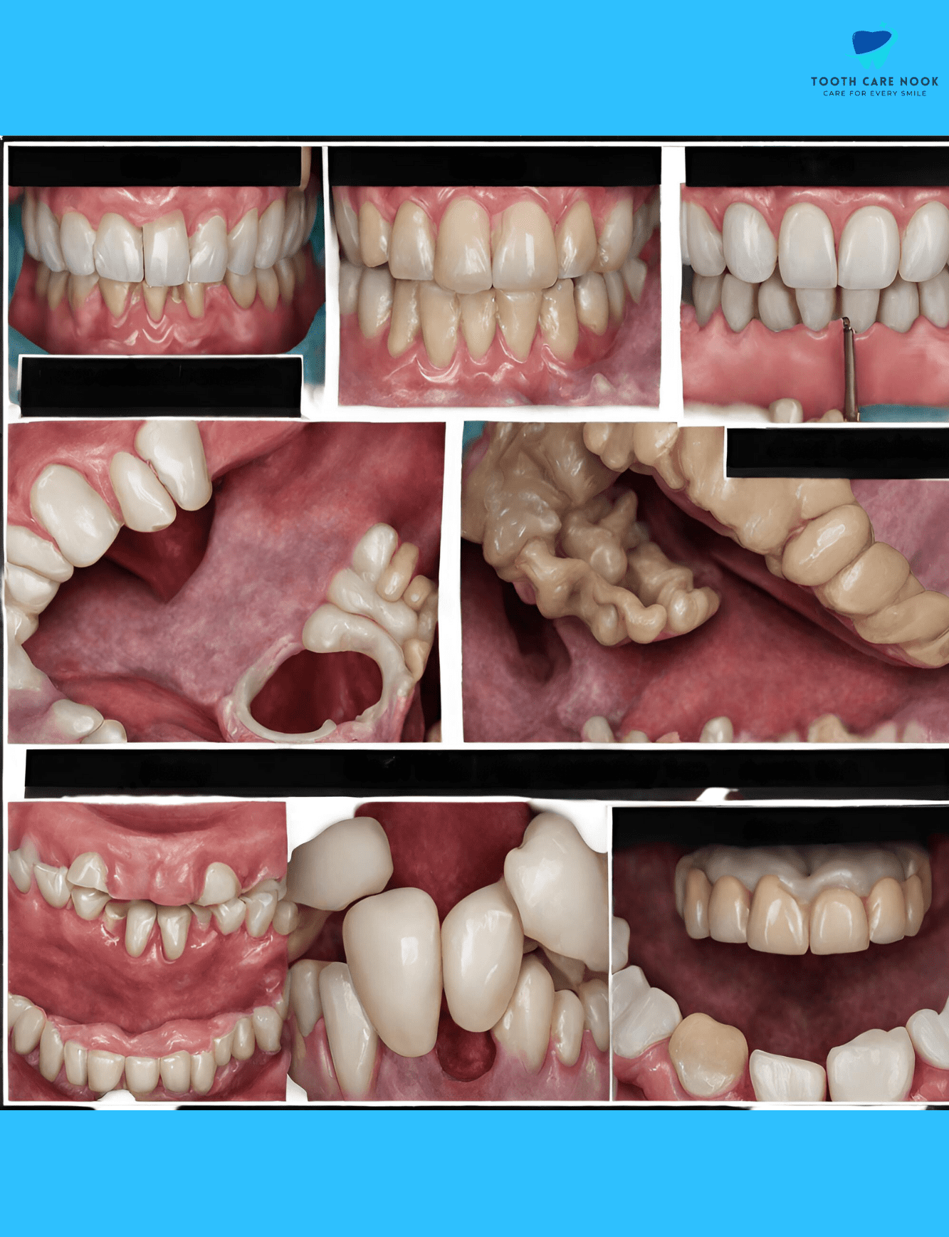 Dental Vestibuloplasty