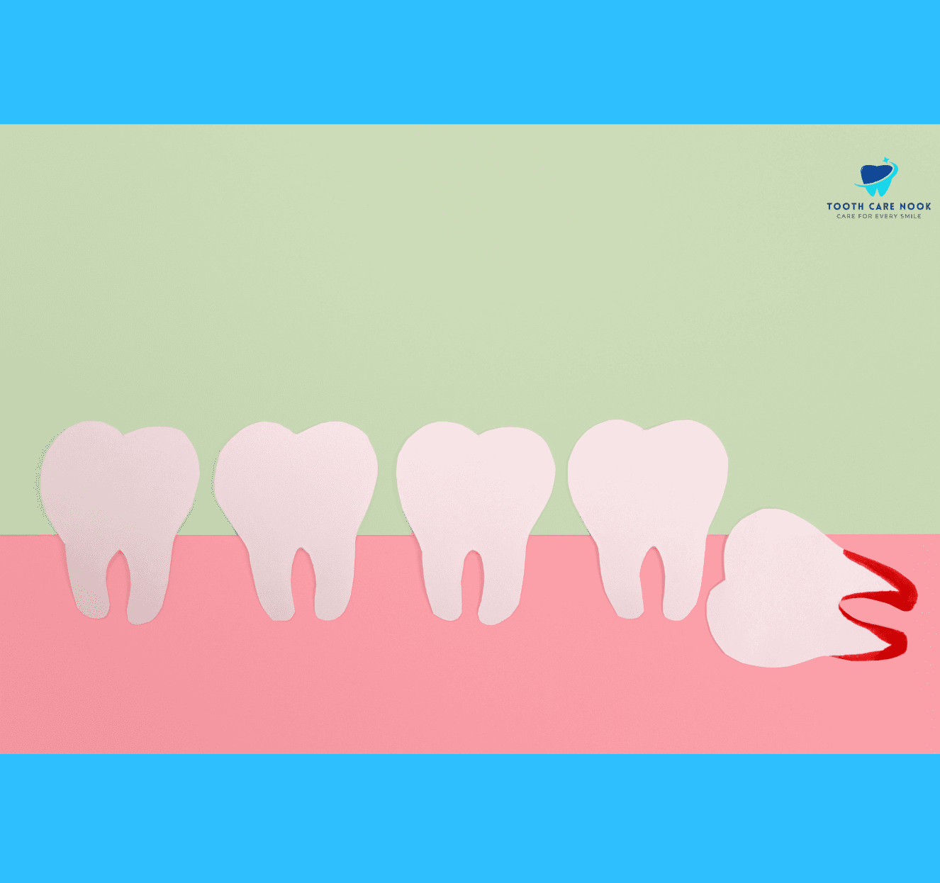 Impacted Tooth 