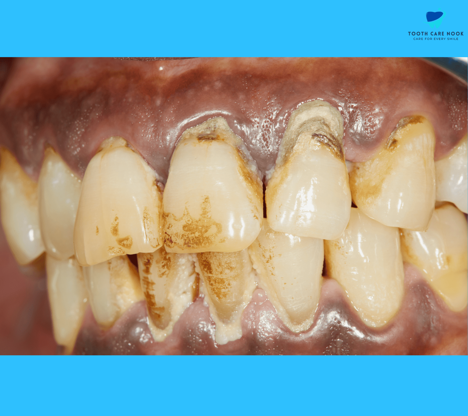 Necrotizing Periodontal Disease