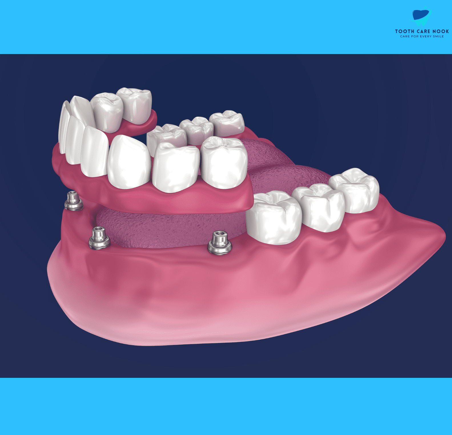 Overdenture