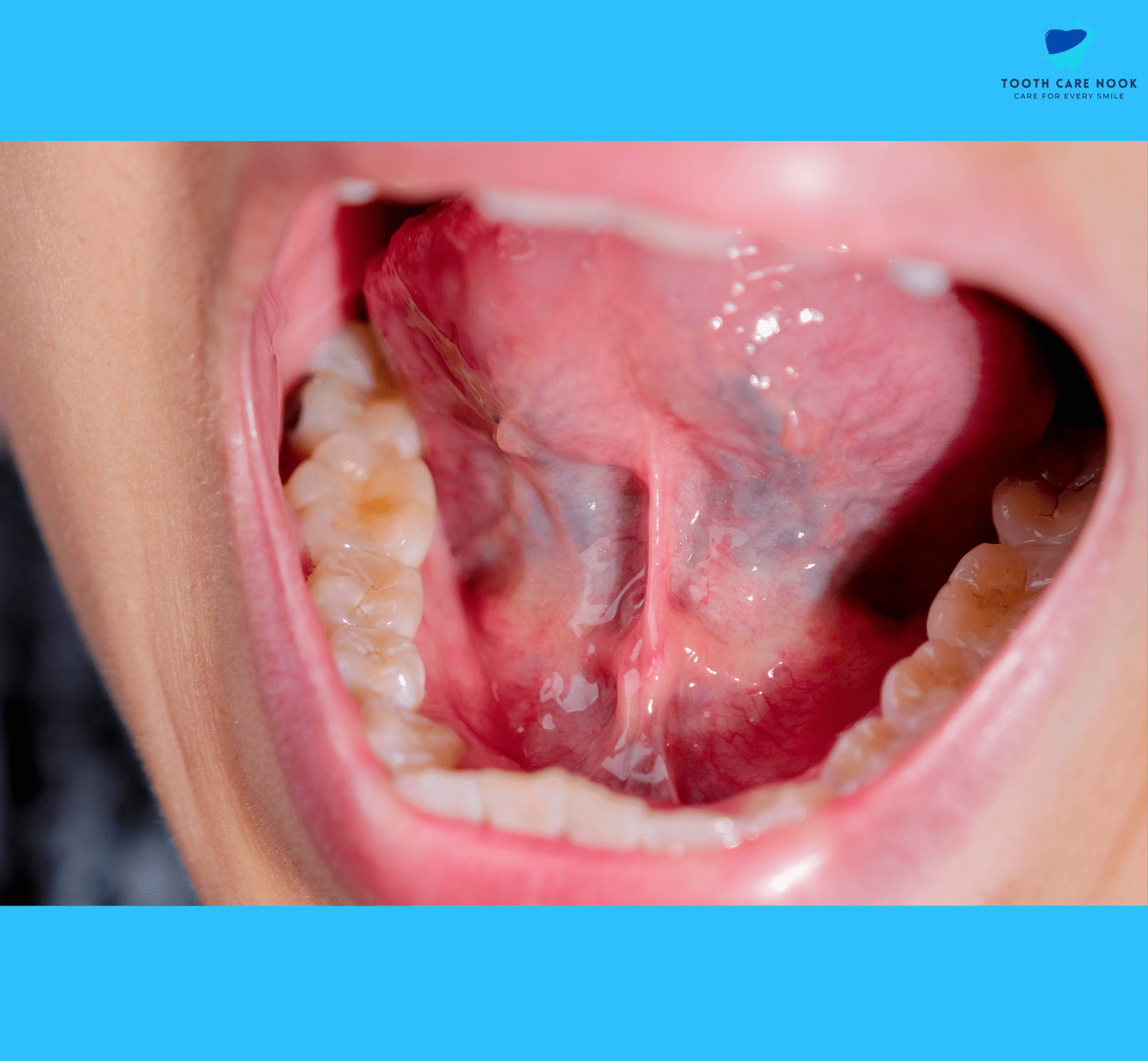 Palatal