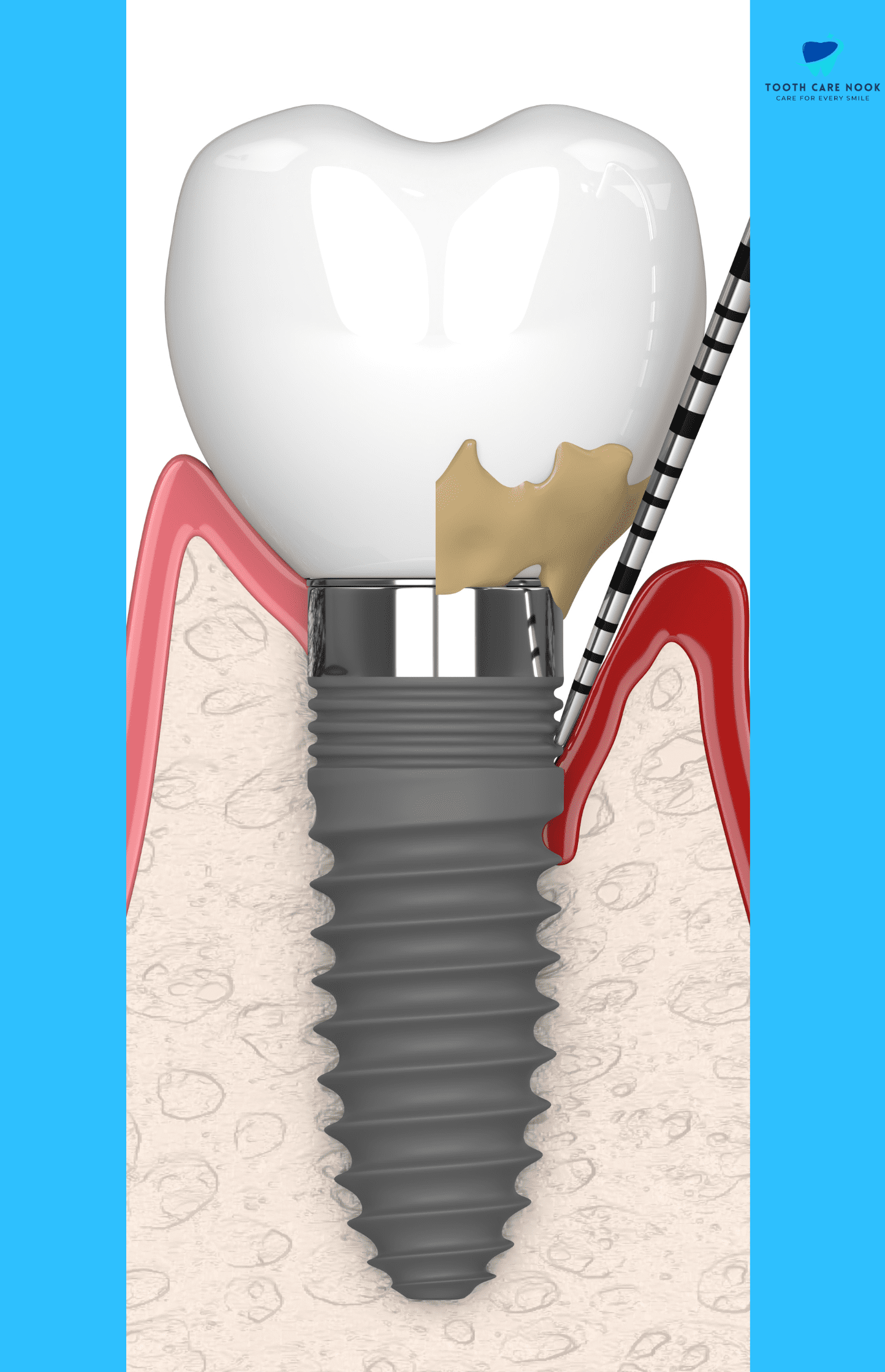 Periodontitis