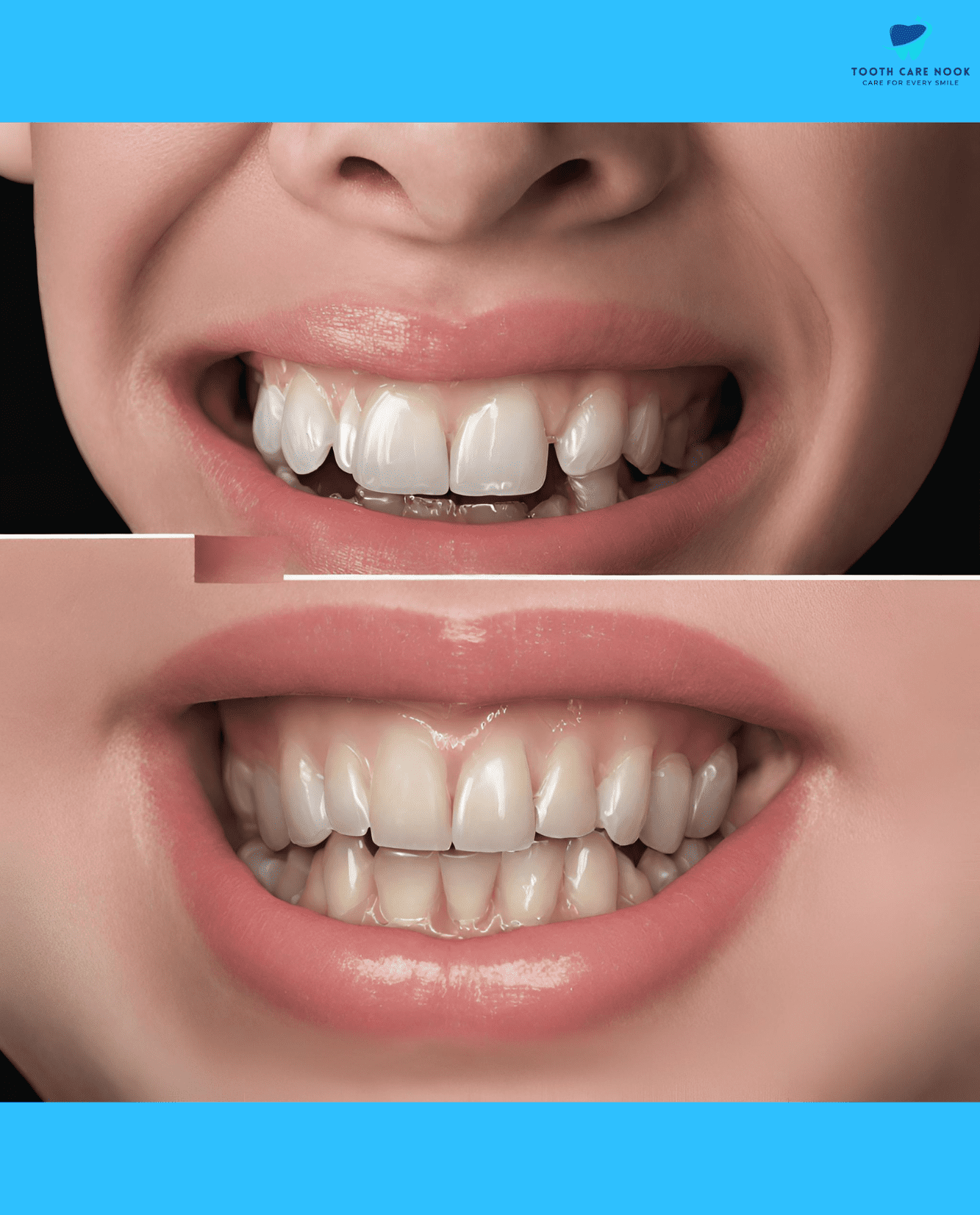 Subgingival