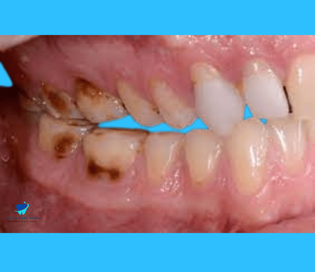 Dental Erosion