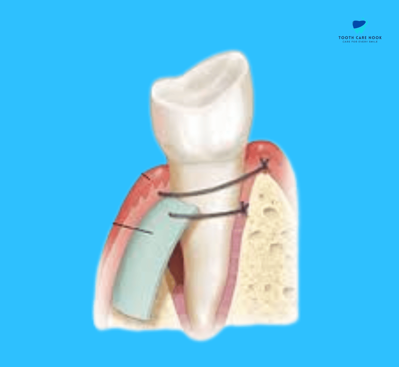 Guided Tissue Regeneration