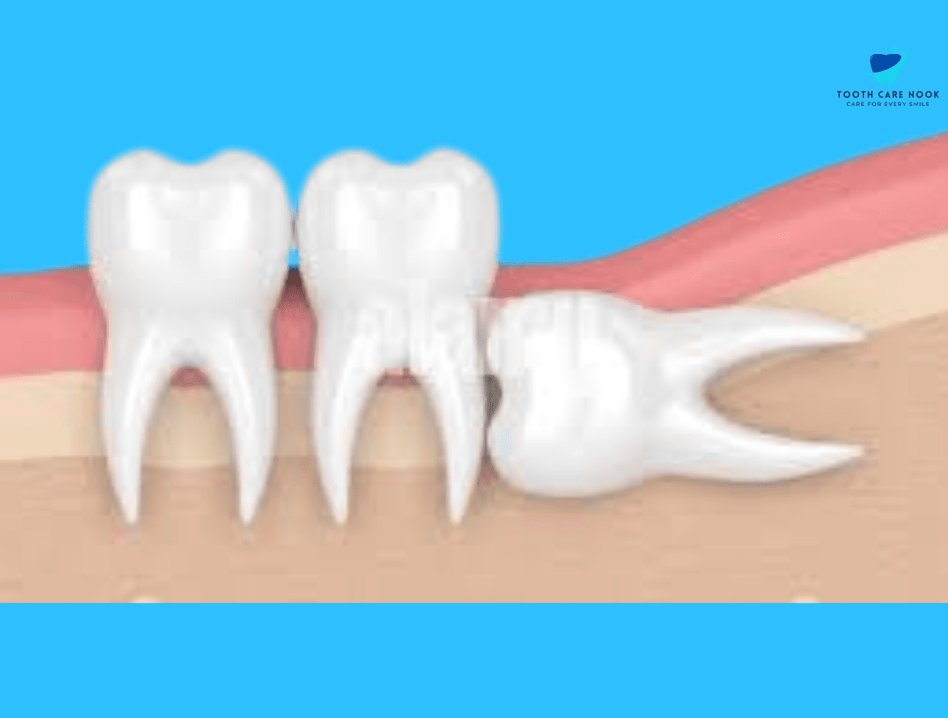 Horizontal impaction