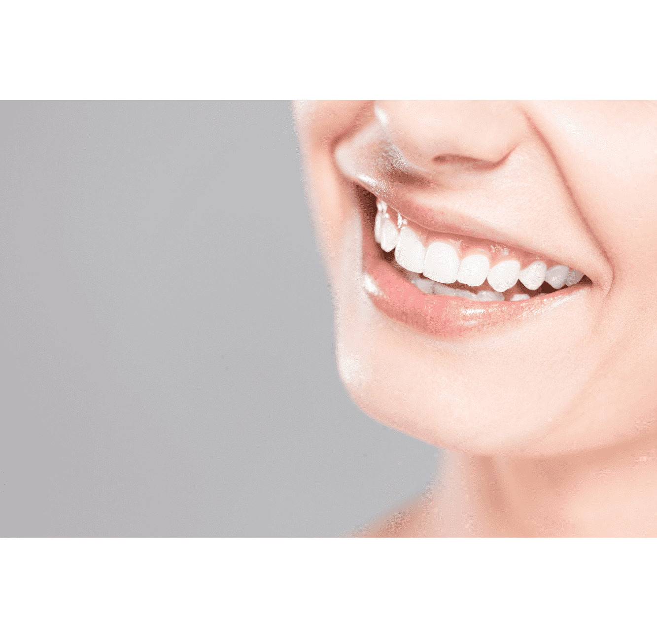 Whiten Teeth Bonding