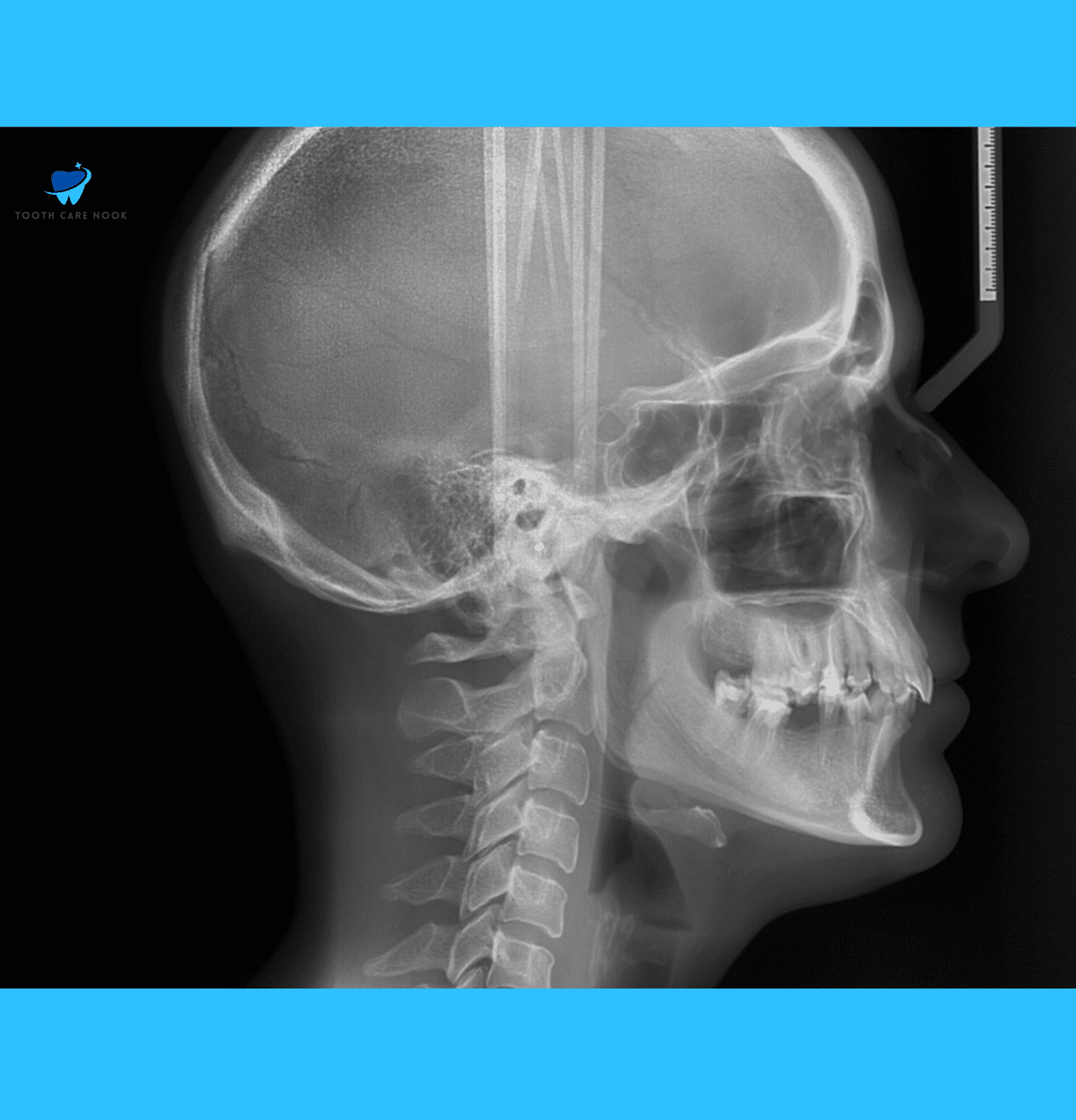 Lateral Cephalometric Radiograph