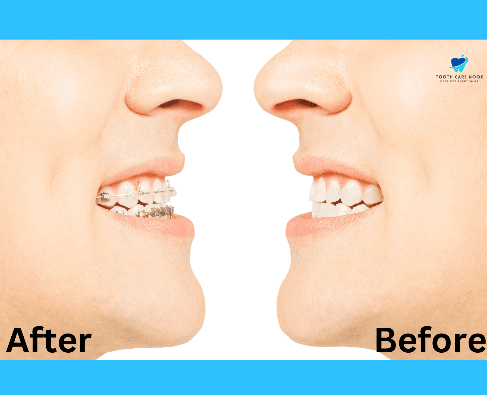 Bite Plate Before and After 