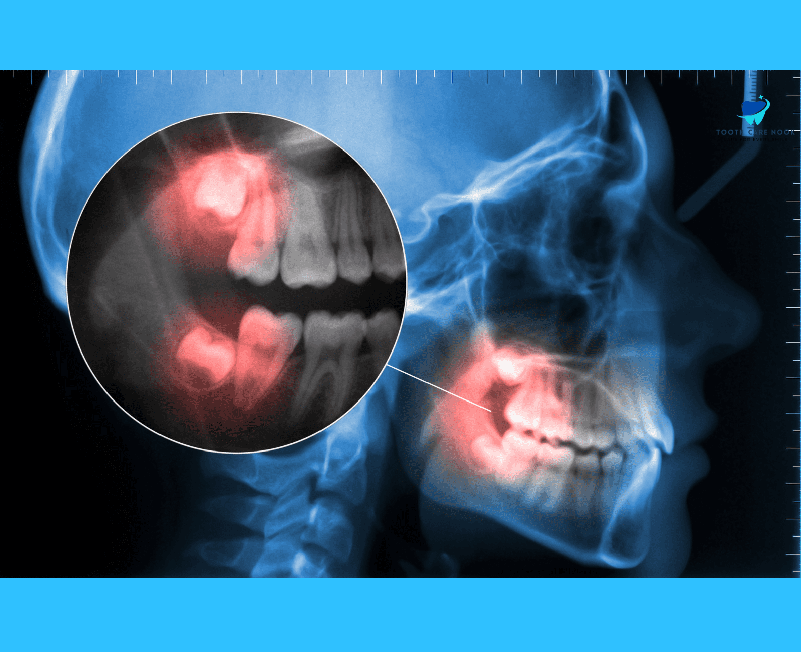 Cephalometric Analysis