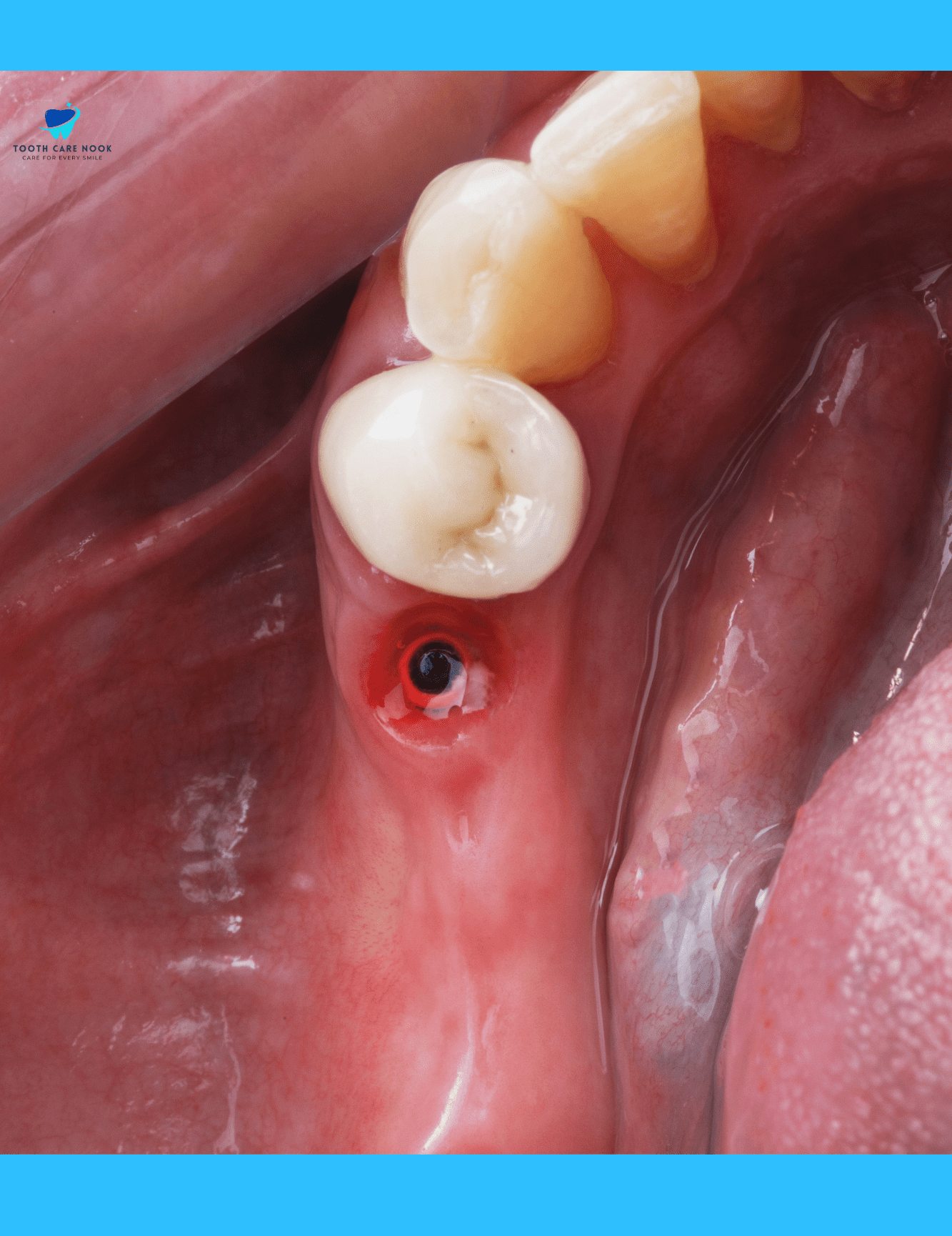 Dental Ridge Resorption