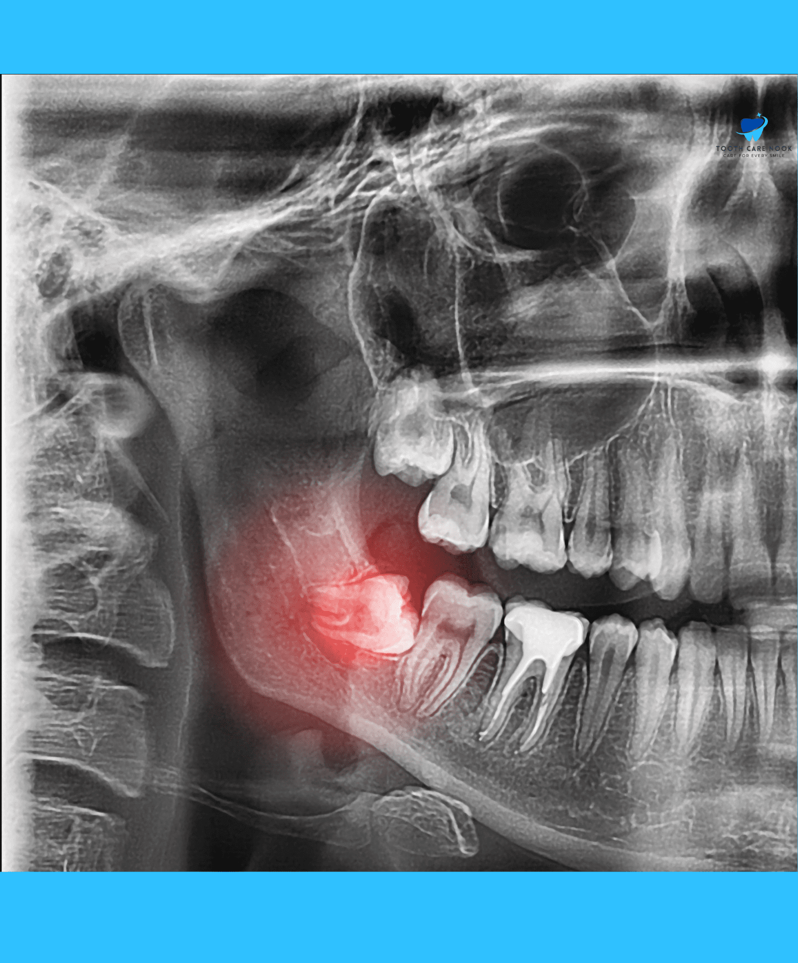 Problems Can Wisdom Tooth Cause 