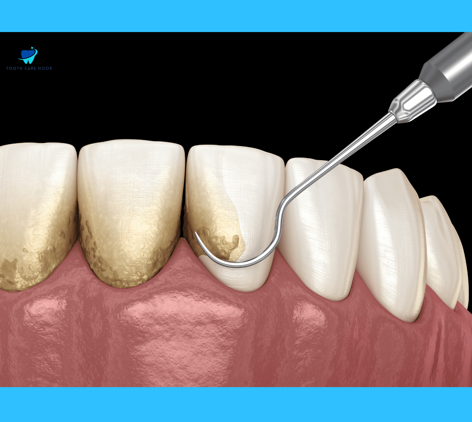 Laser Gum Removal Procedure  