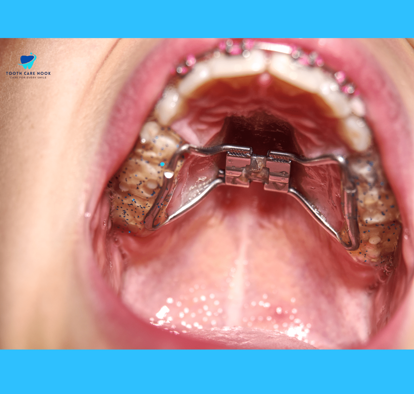 Palatal Expander