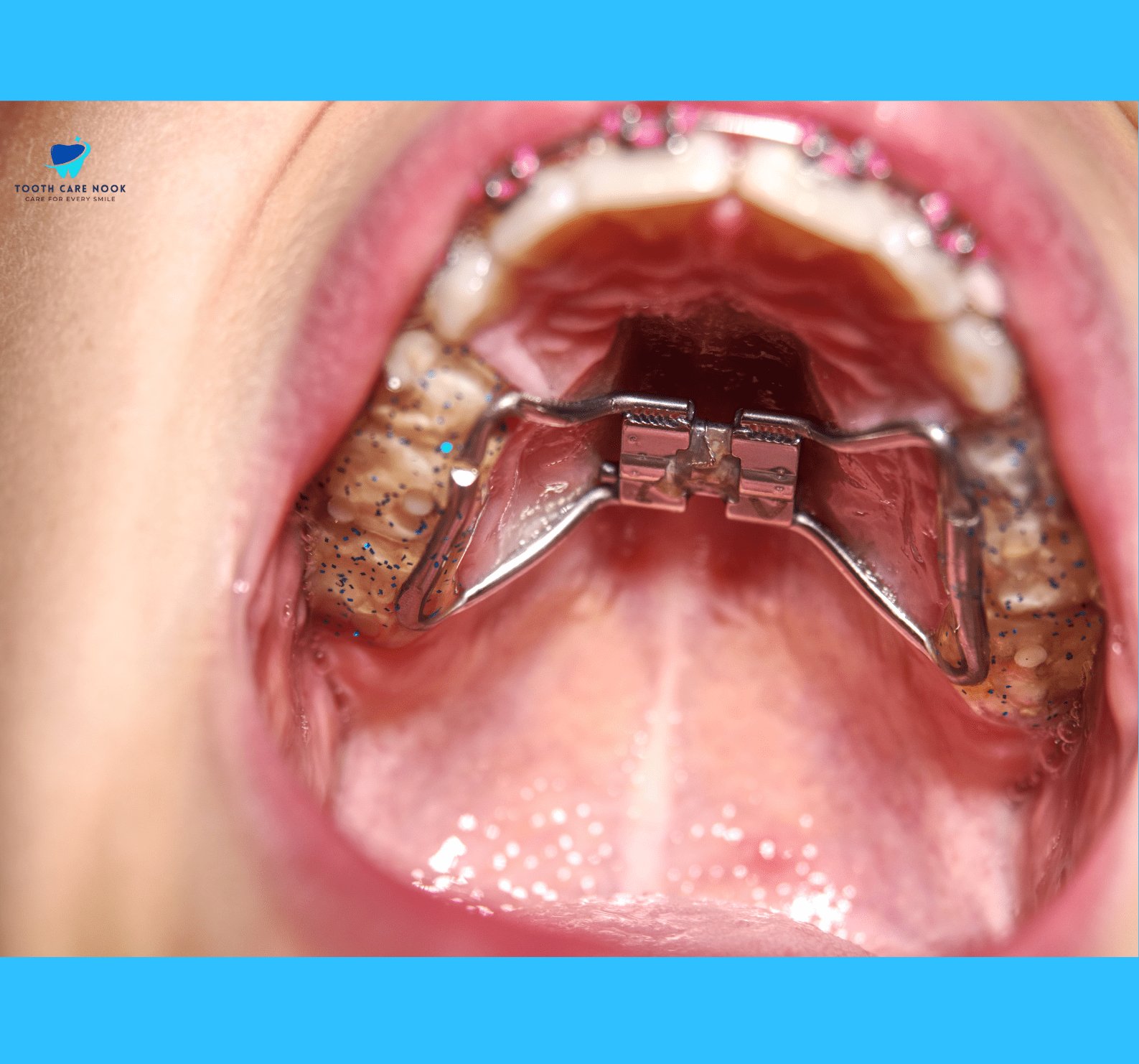 Palatal expanders