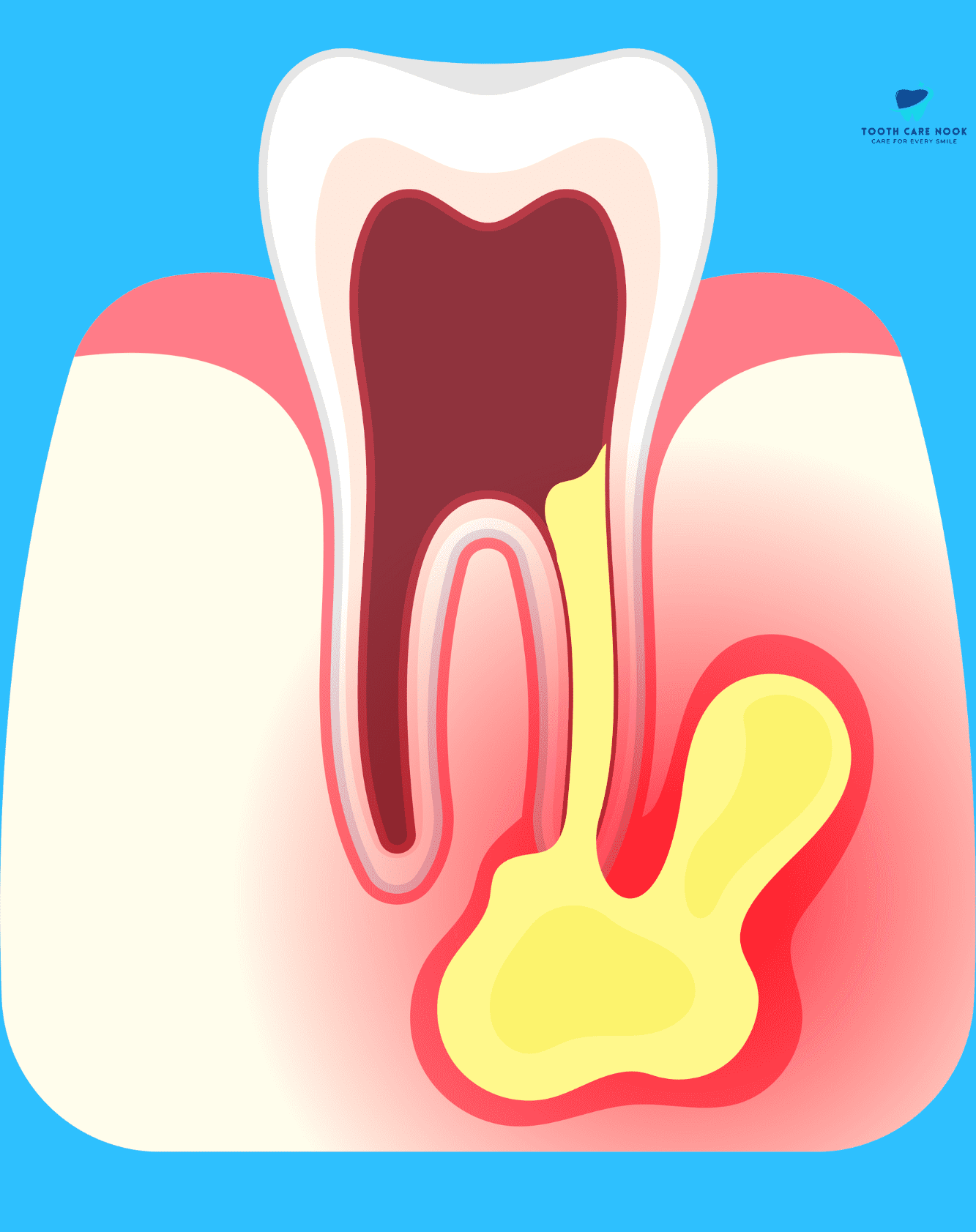 Periapical