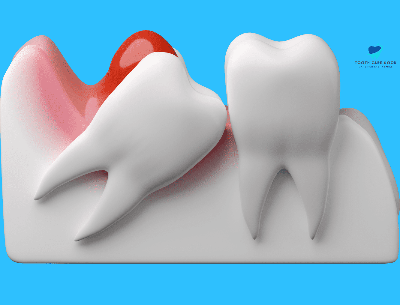 Pericoronitis