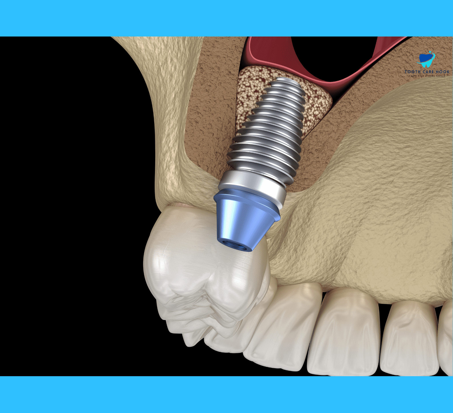 Sinus Lift