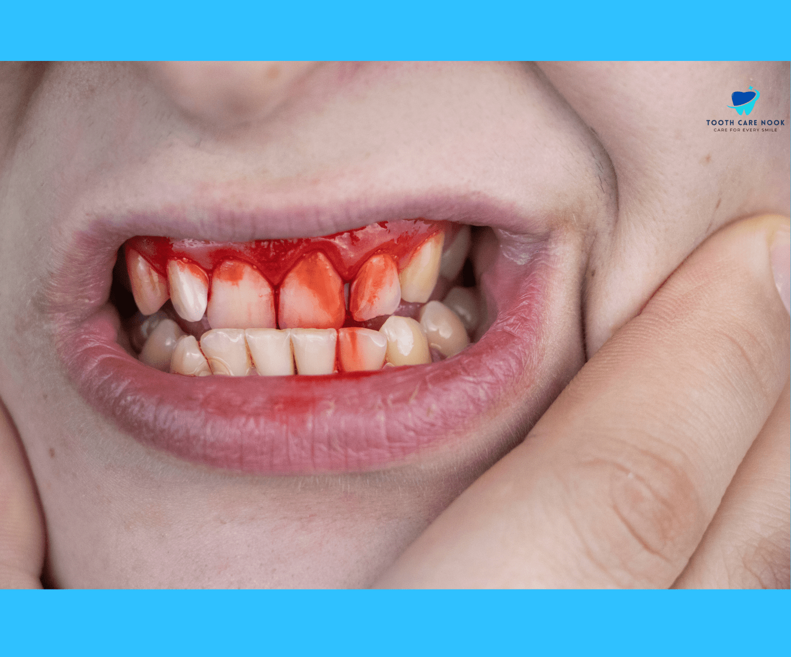 Symptoms of Gum Recession  