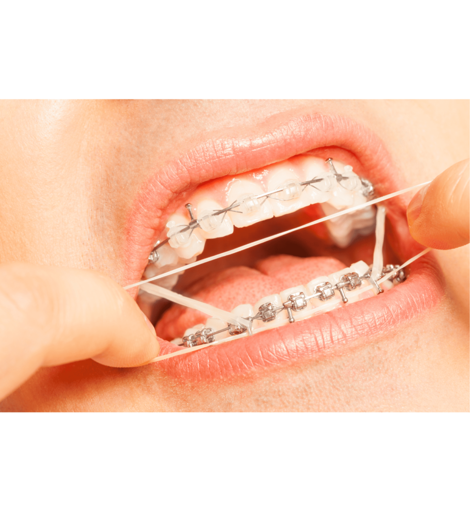 Triangle Rubber Bands For Braces