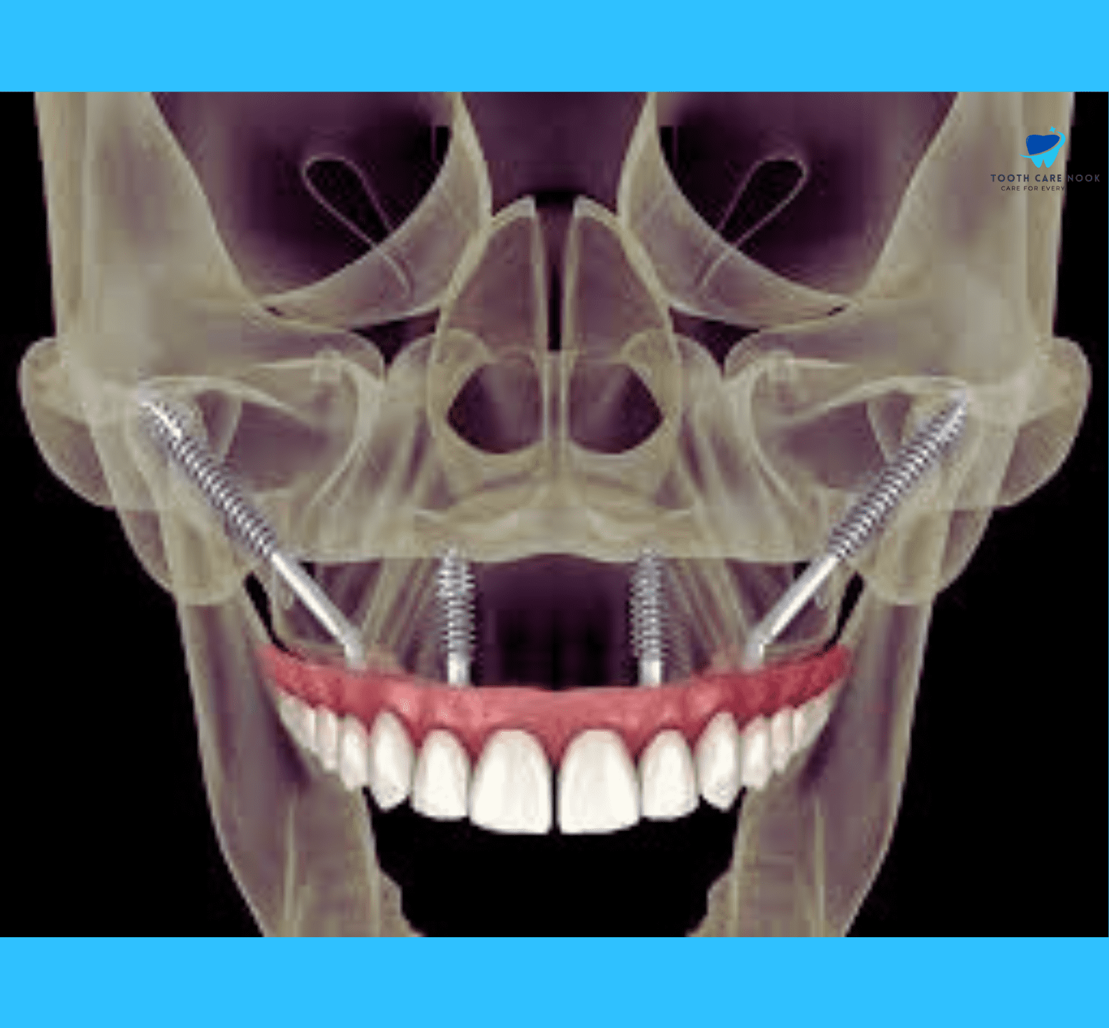 Zygomatic Implants