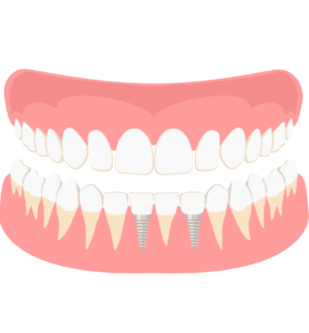 3 on 6 Dental Implants