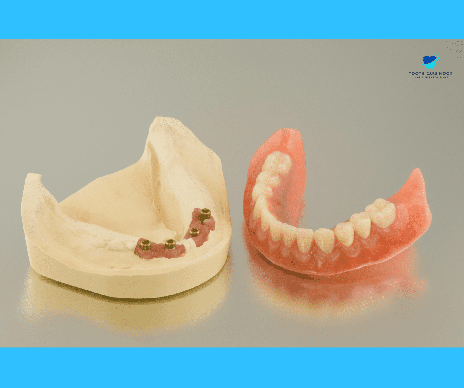 How Long Does an All-on-4 Denture Last