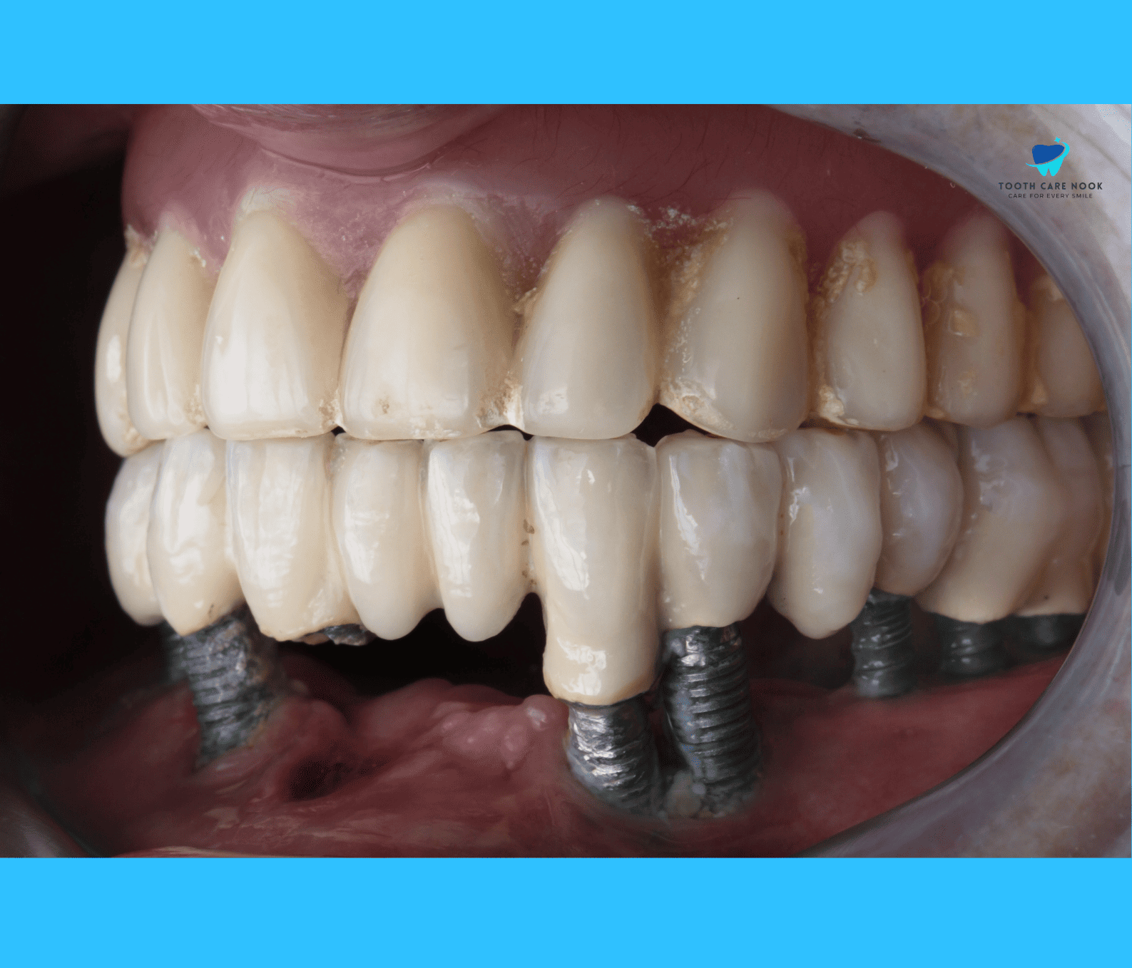 Full Mouth Dental Implant