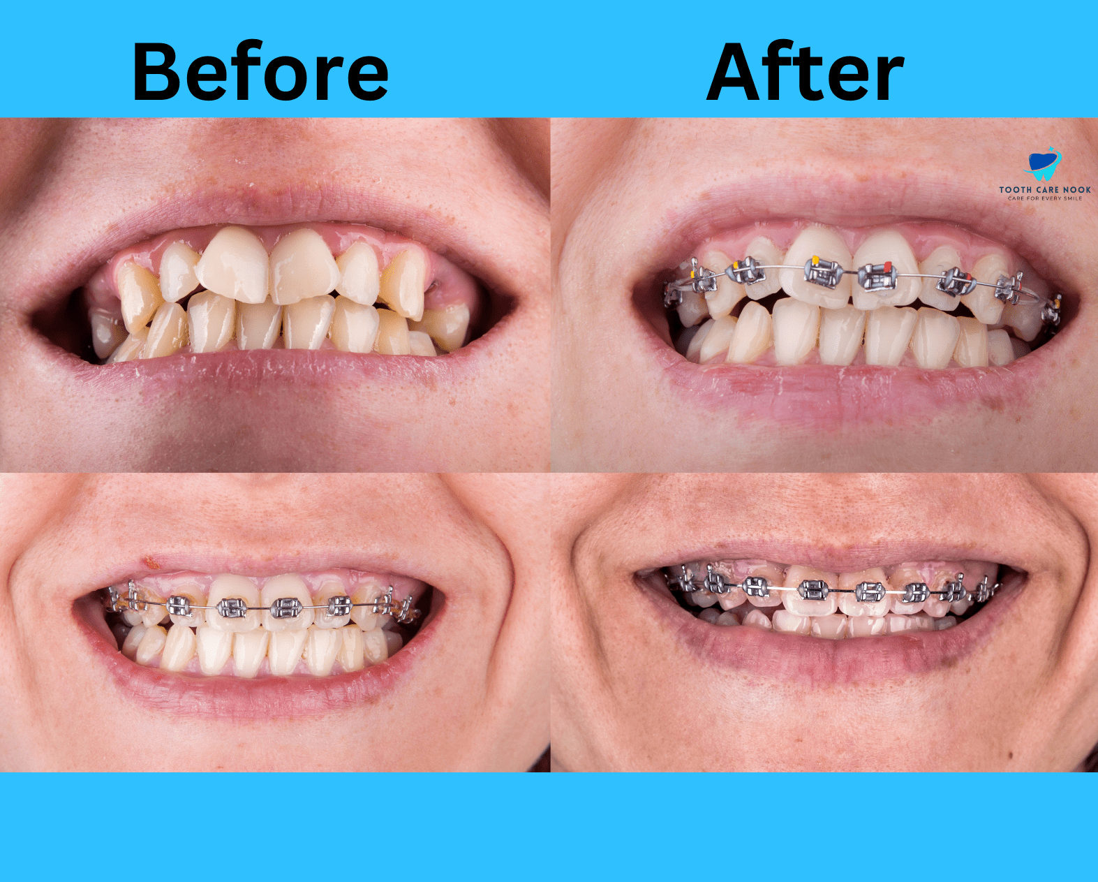 Braces Before And After Overcrowding