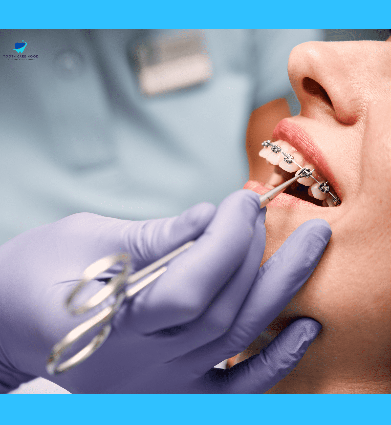 Braces Bonding Procedure 