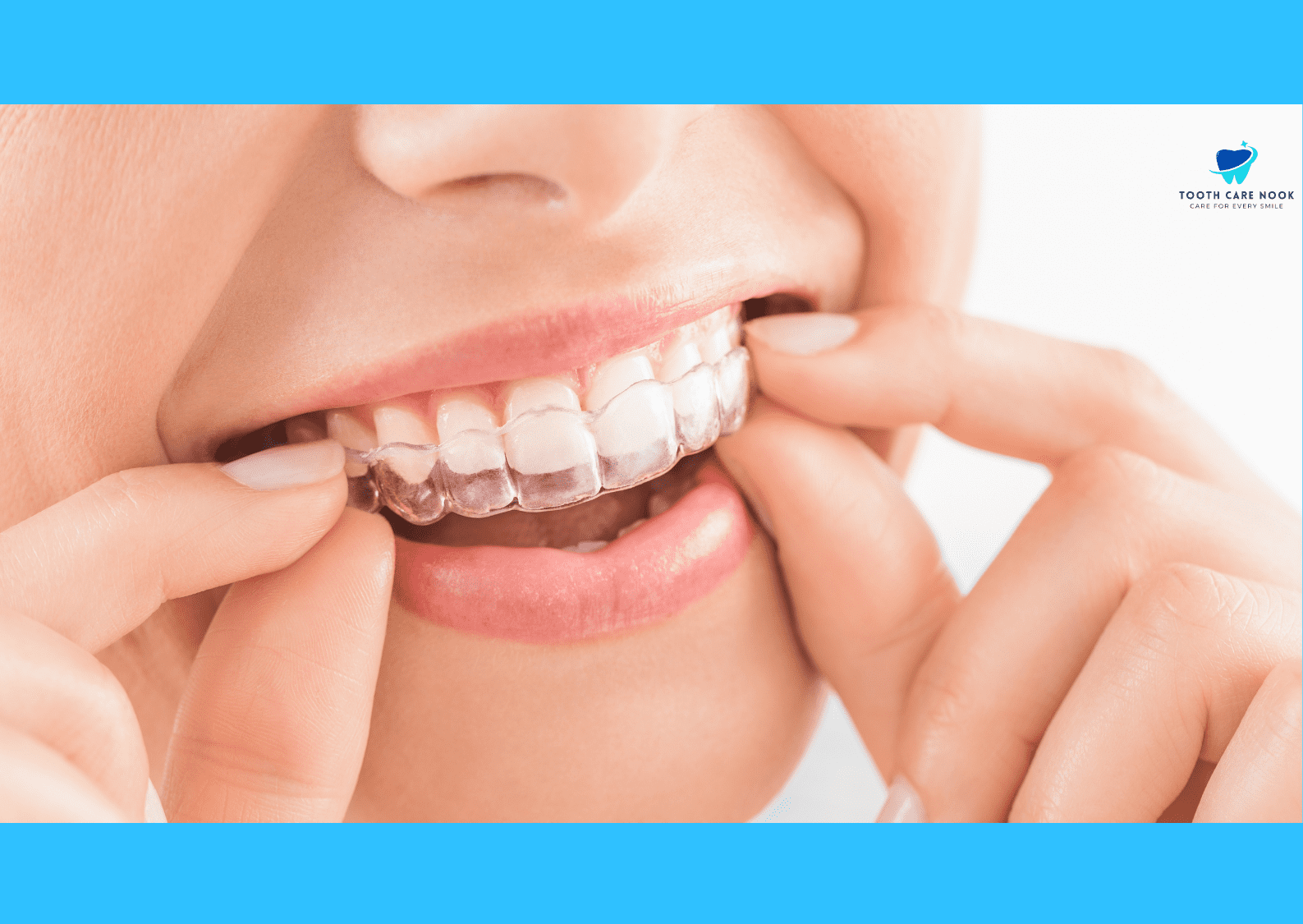 Caring Tips for Bonding Teeth