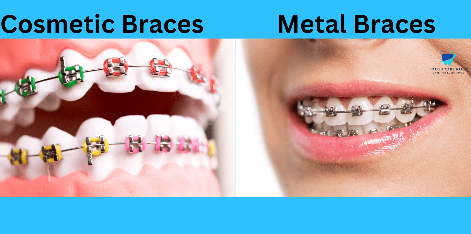 Cosmetic Braces vs Metal Braces 