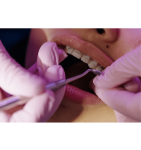 Dental Cleaning With Braces 