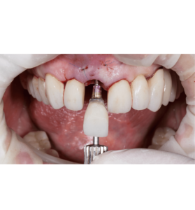 How Long Does Swelling Last After Dental Implant  