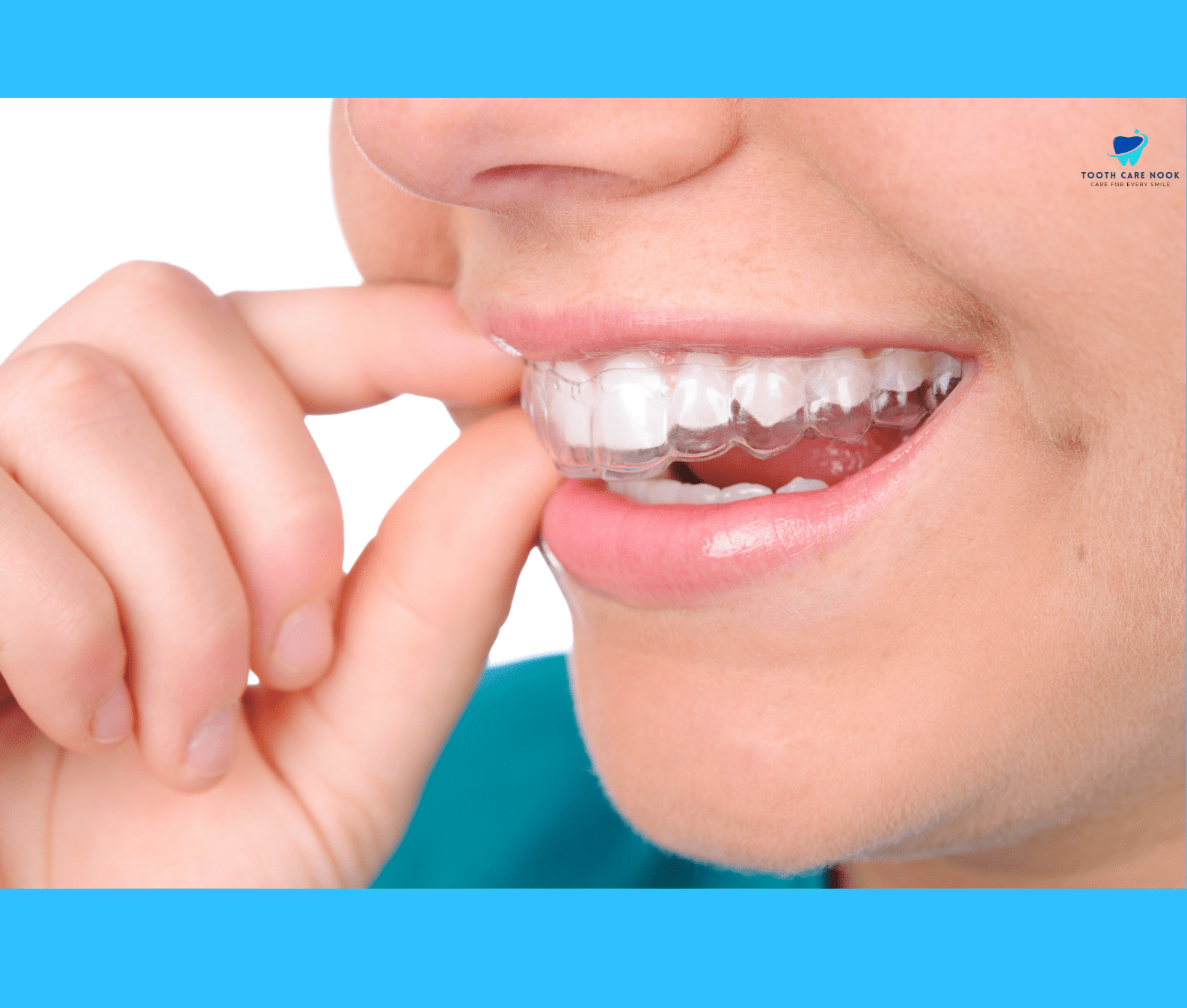 How to Care for Your Dental Retainers