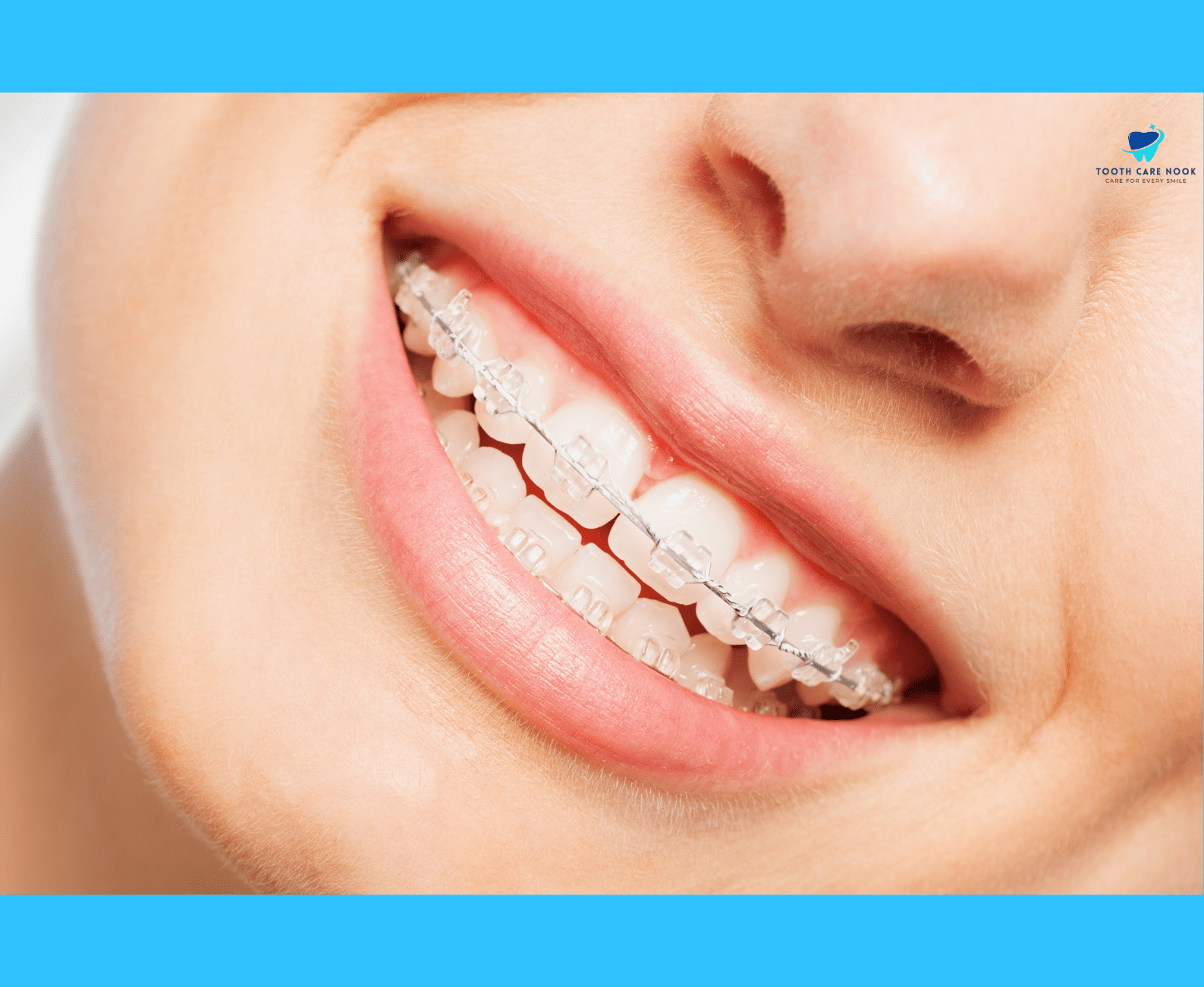 Process of Changing Wires on Braces 