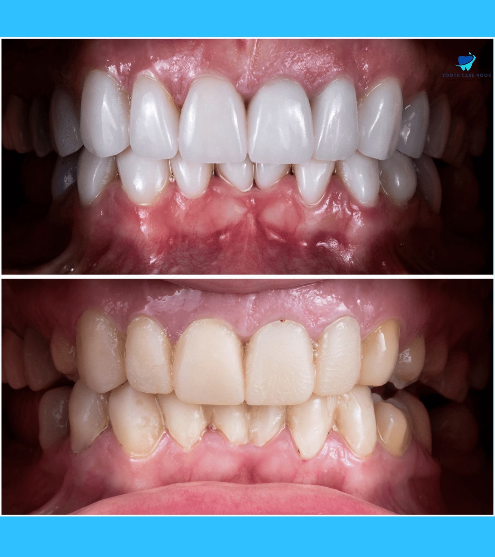 Porcelain Veneers